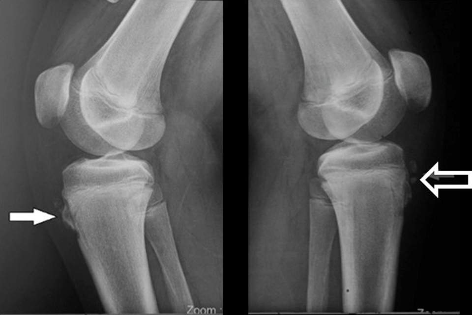 OSGOOD SCHLATTER